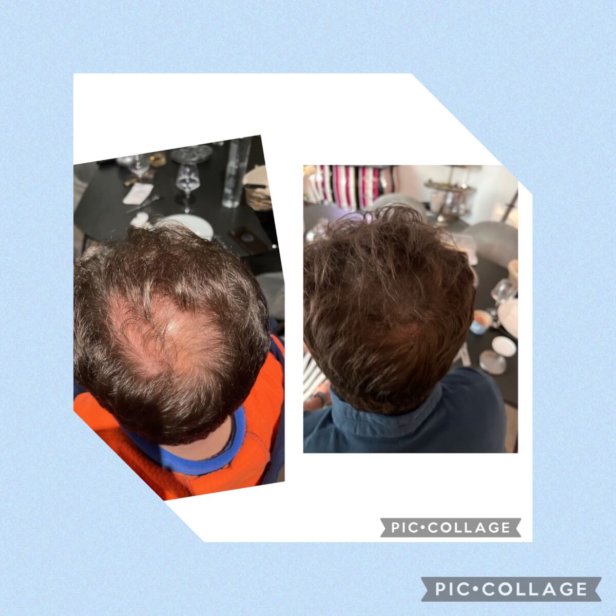 tricopigmentation-la-solution-pour-camoufler-un-debut-de-calvitie