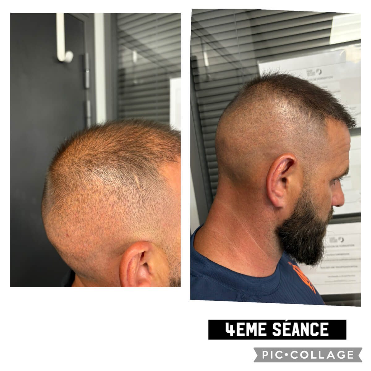 camoufler-avec-la-tricopigmentation-le-mokka-coiffure