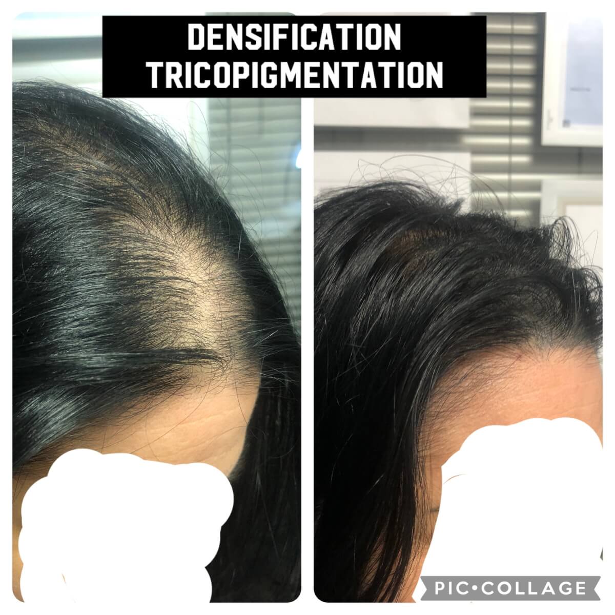 la-tricopigmentation-pour-les-femmes-une-solution-eclatante