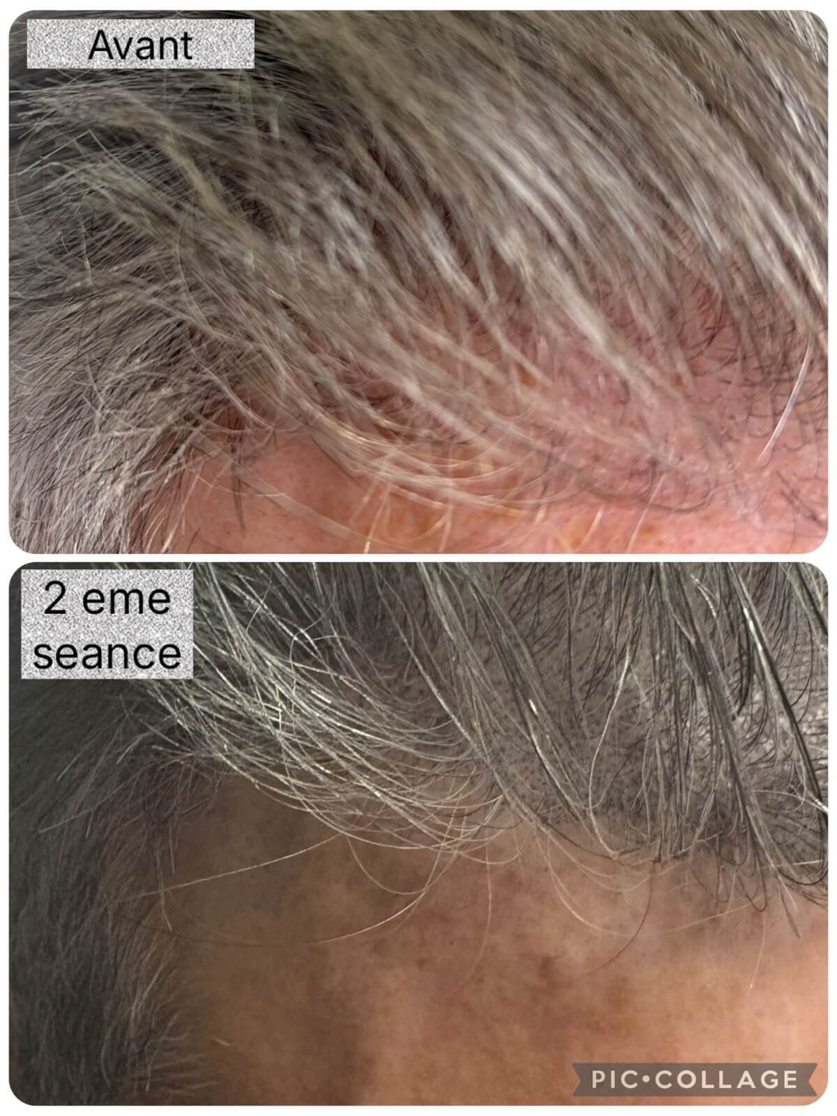 tricopigmentation-densifiez-vos-cheveux-clairsemes